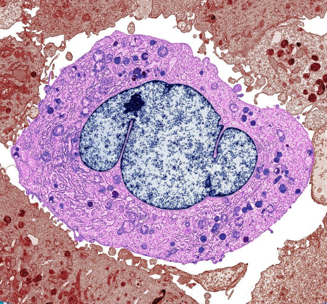 Lung cancer cells, TEM