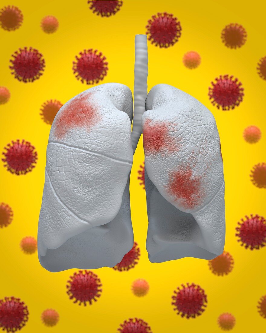 Covid-19 infection, conceptual illustration