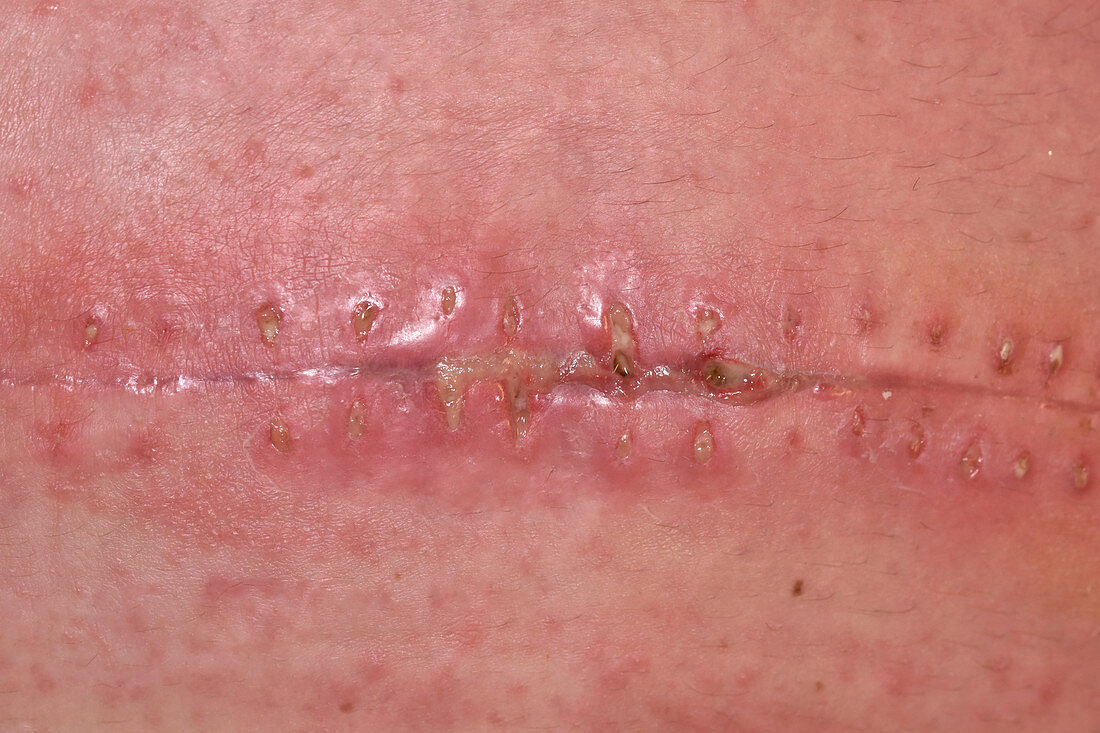 Infected surgical wound
