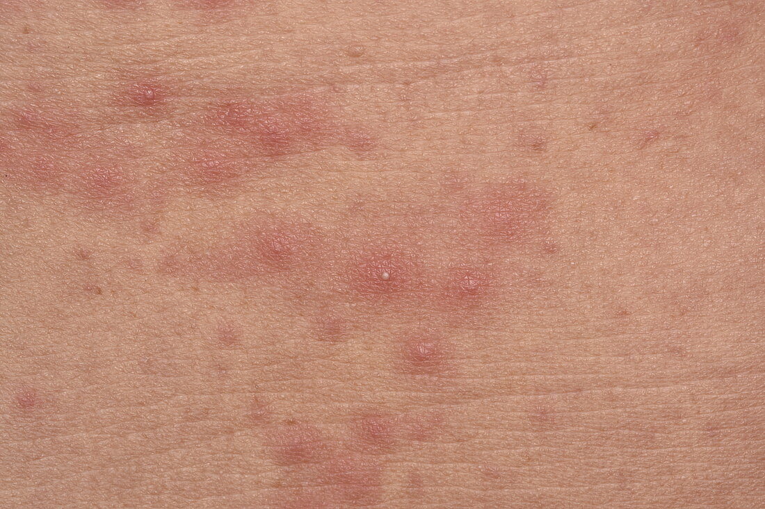 Folliculitis of the chest