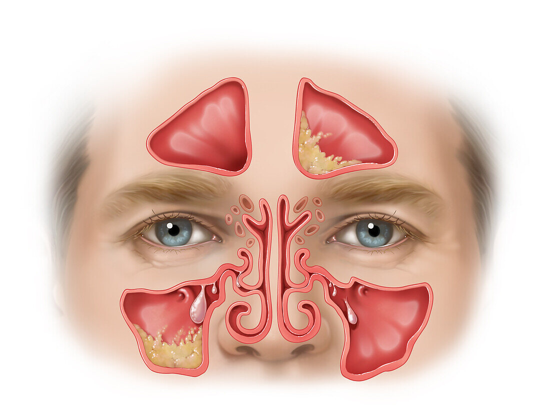 Swollen Infected Sinuses with Polyps, Illustration