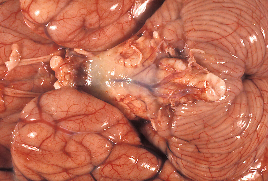 Human Brain, Meningitis