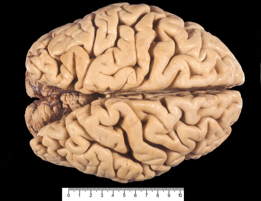 Human Brain, Atrophy of Cerebral Cortex
