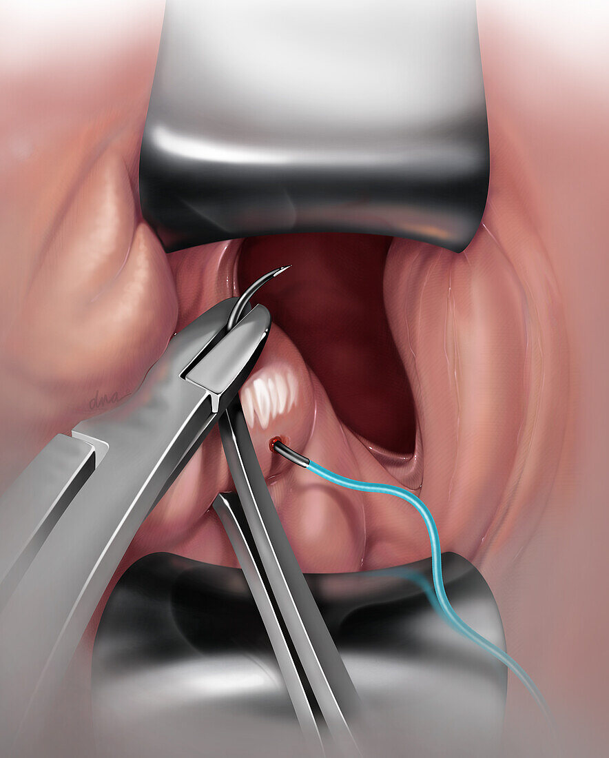 Surgery for Iatrogenic Injury, Illustration