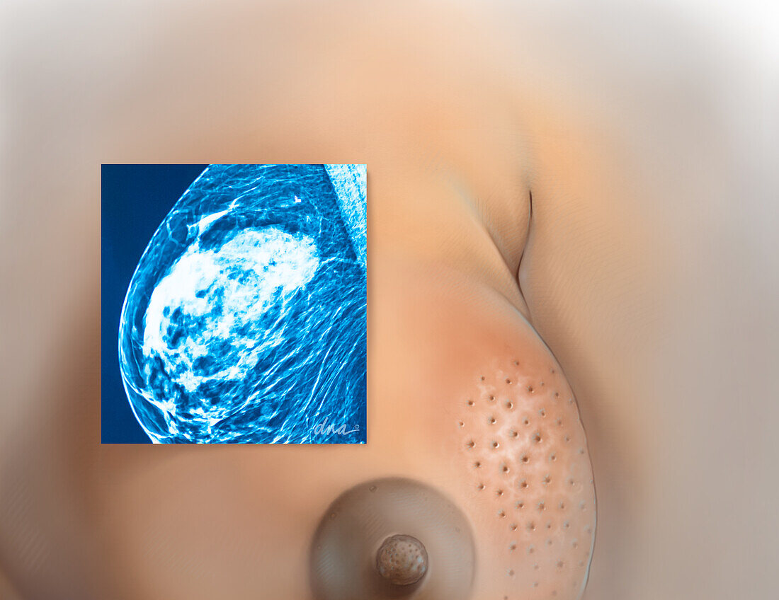 Breast Health, Illustration