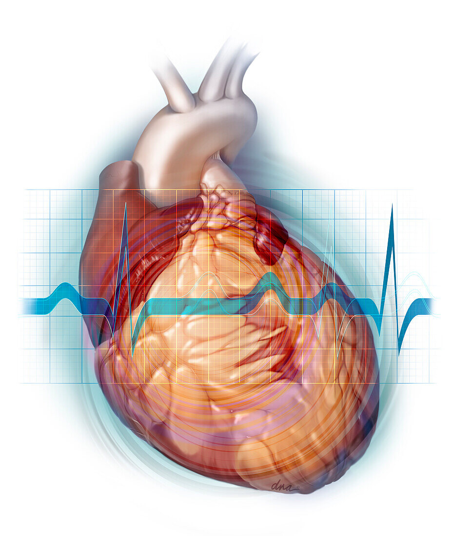 Cardotoxicity Resulting in Decreased Ventricular Function , Illustration