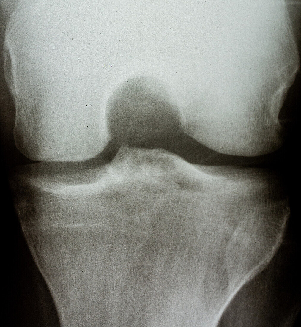 X-ray of Knee, Dorsal View
