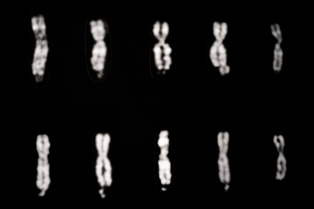 Fragile-X Chromosomes and Normal X Chromosomes