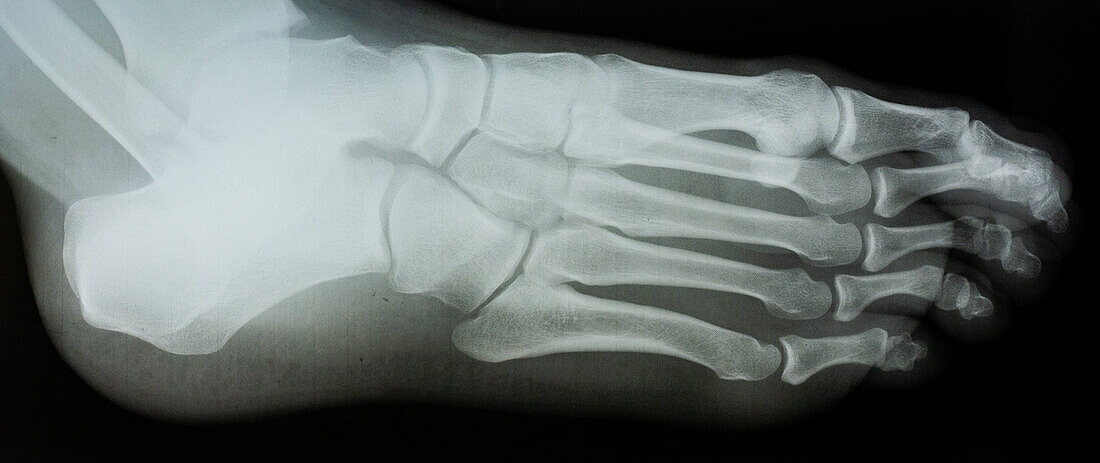 X-Ray, Ventral View of Left Foot