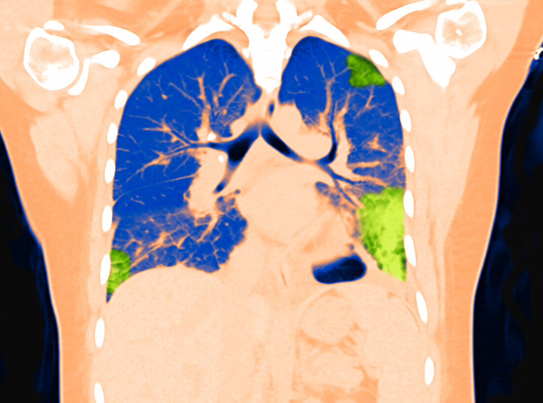 Lungs with Vaping Damage, Baseline CT