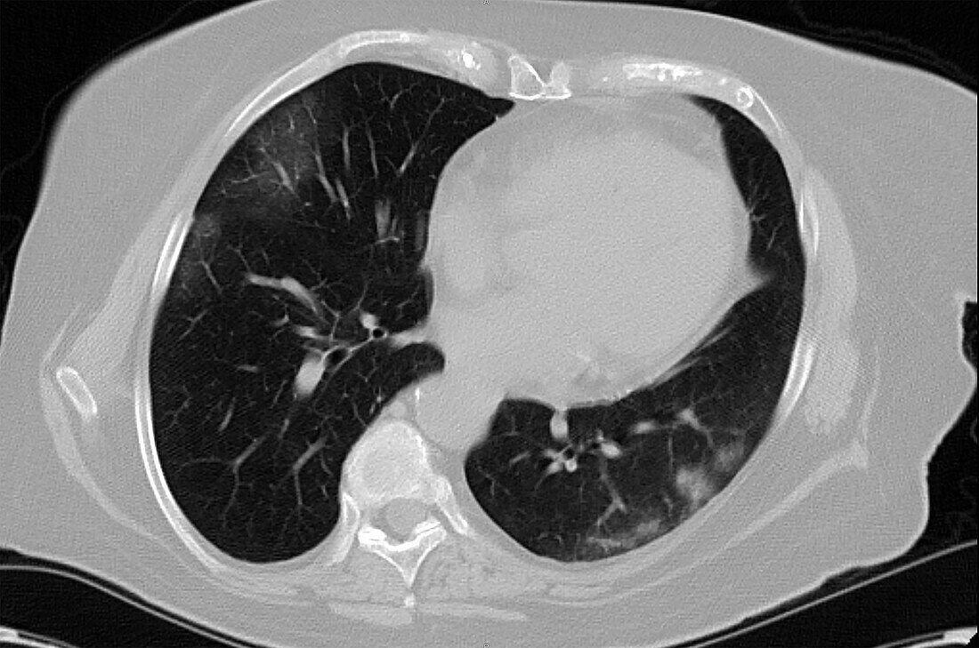 COVID-19 Lungs, CT Scan