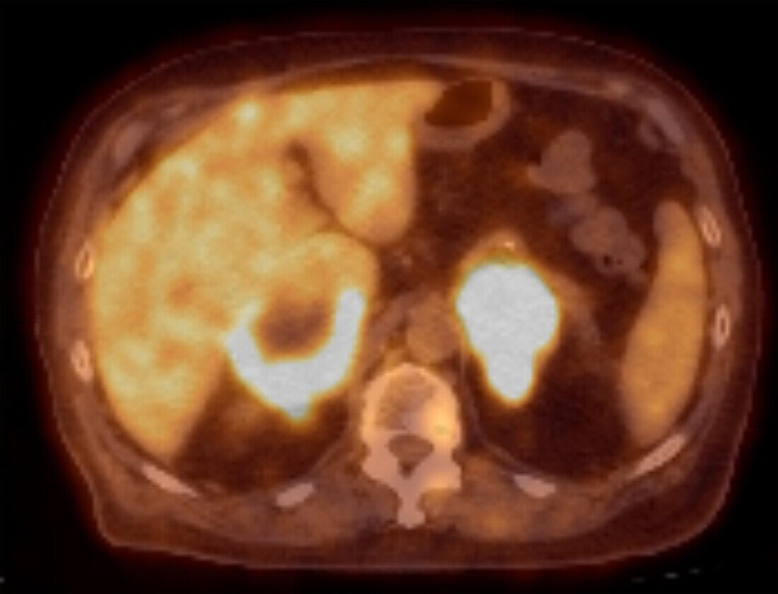 Adrenal Cancer, PET-CT Scan