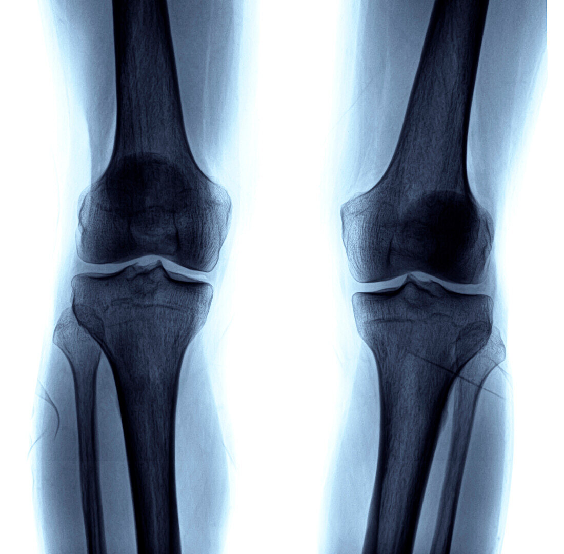 X-Ray of knees