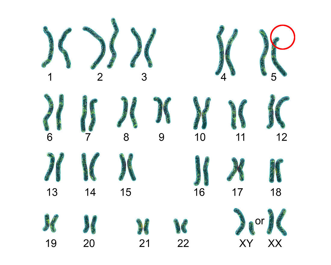 Cri du chat syndrome karyotype, illustration