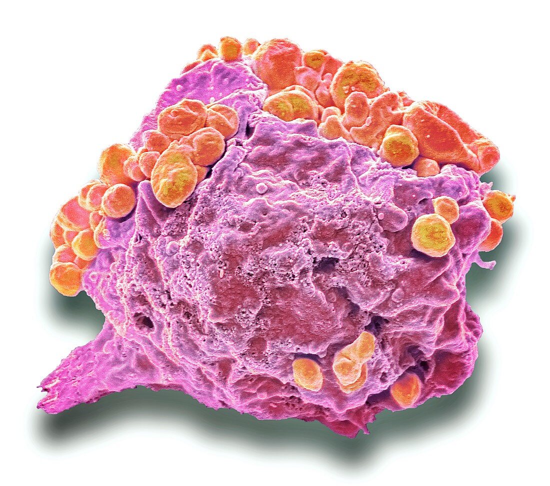 Lymphoma cancer cell, SEM