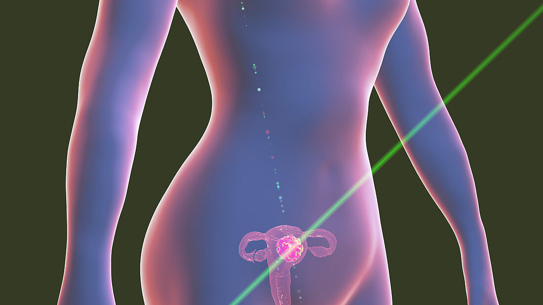 Uterine cancer, conceptual illustration
