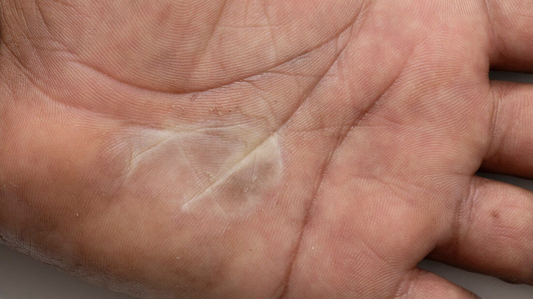 Palm callus