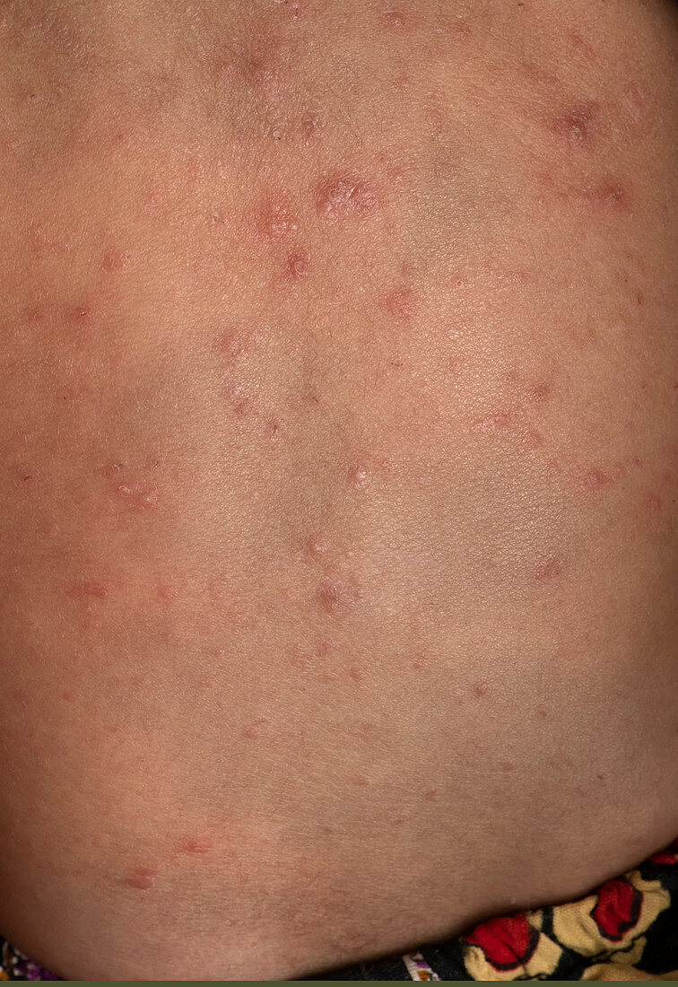 Scabies infection on the skin