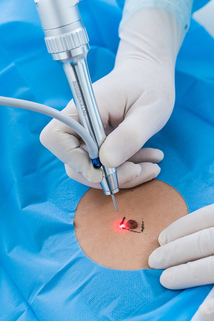 Excision of a nevus (mole) using a CO2 surgical laser