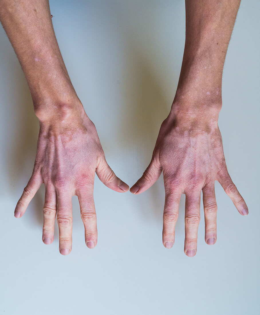 Vitiligo, skin pigment loss