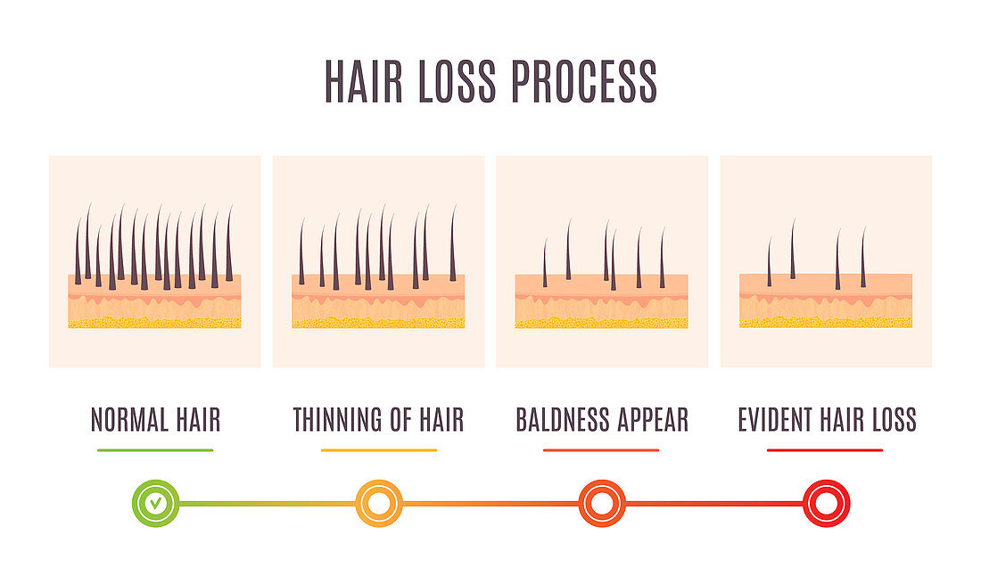 Hair loss stages, illustration