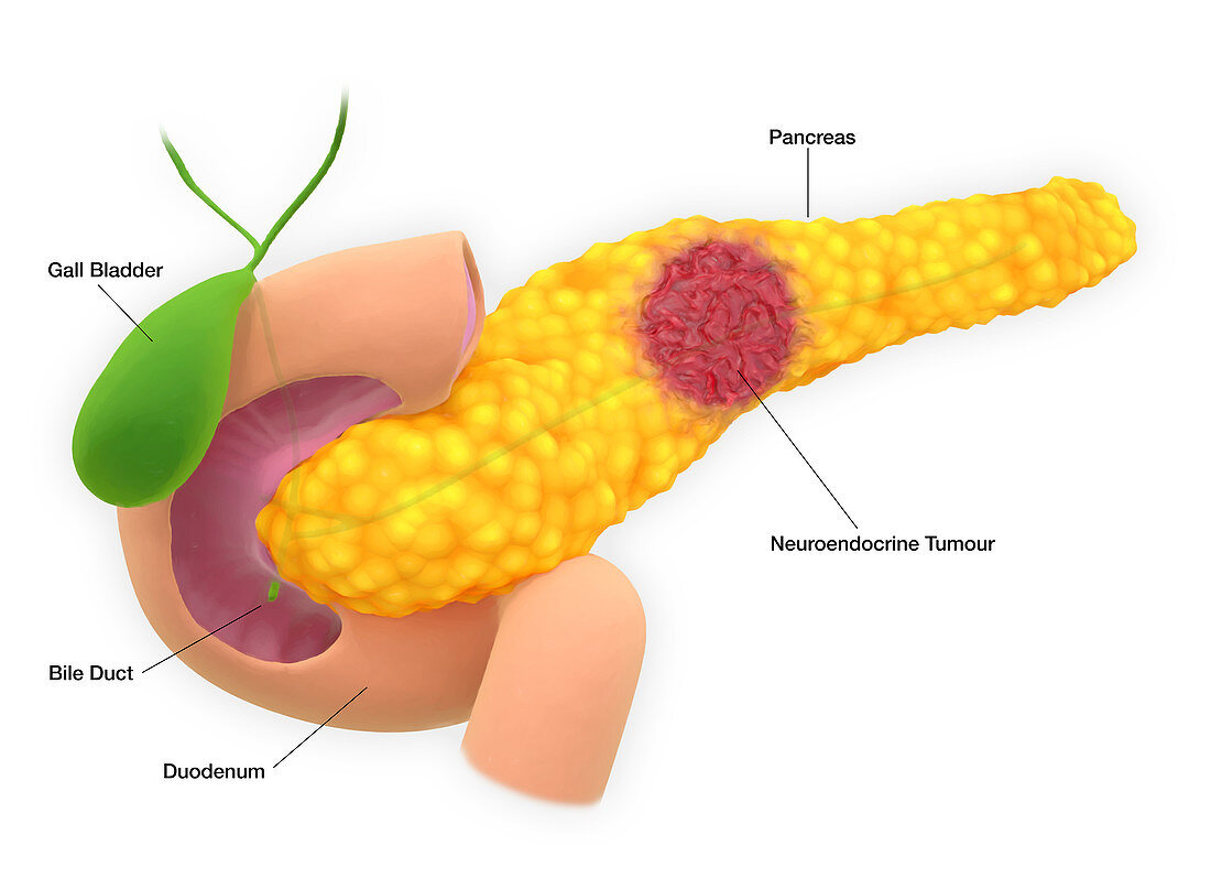 Pancreatic neuroendocrine tumour, illustration