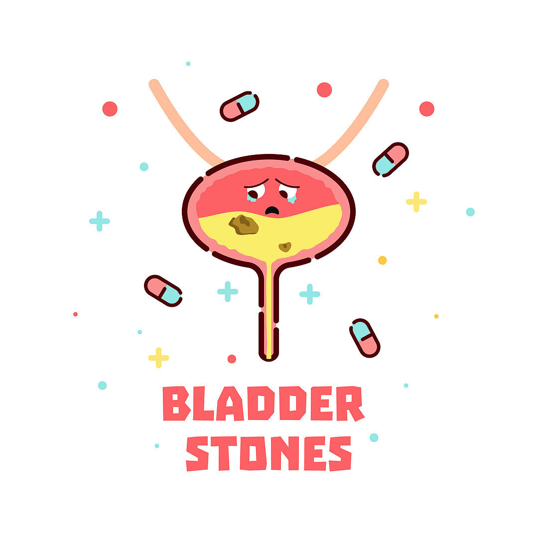 Bladder stone disease, conceptual illustration