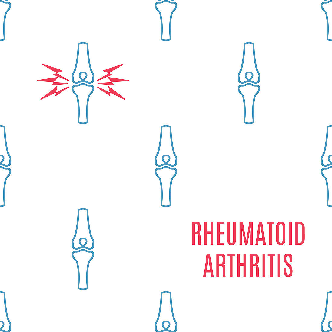 Rheumatoid arthritis, conceptual illustration
