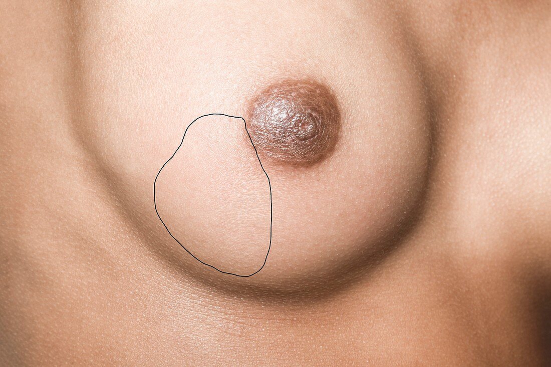 Breast infection