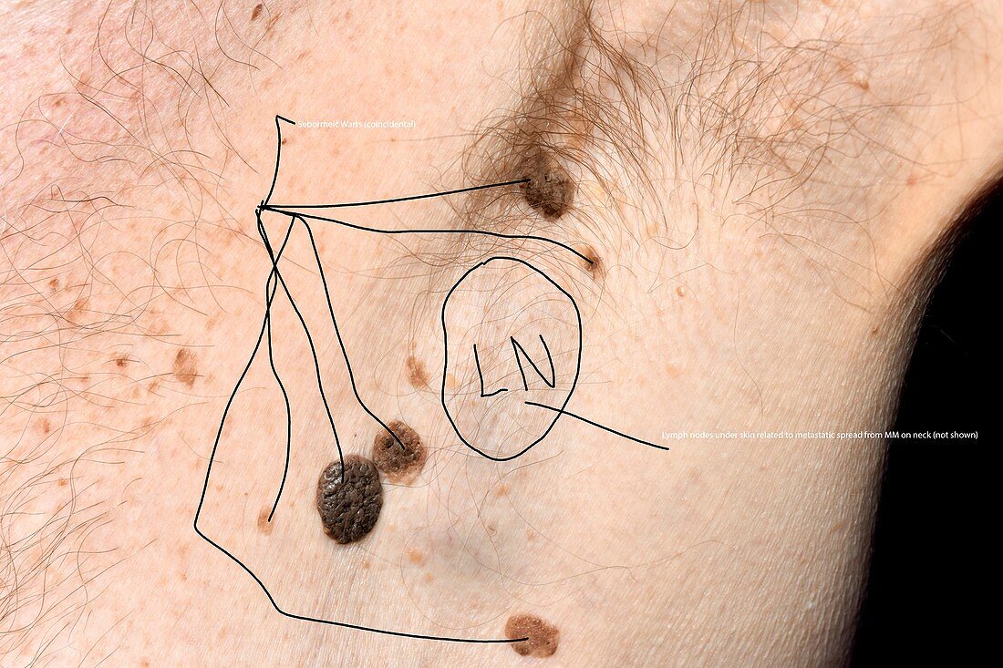 Swollen lymph node in metastatic melanoma