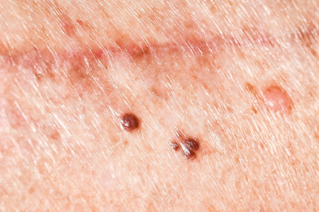 Metastatic melanomas