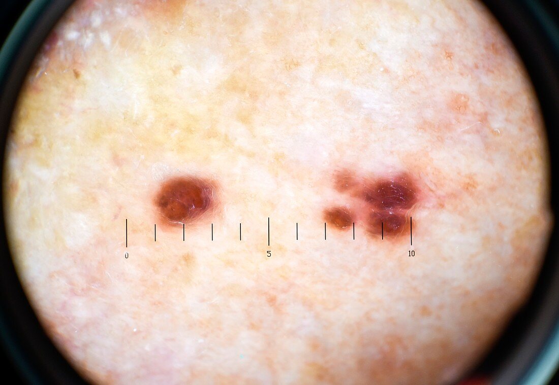 Metastatic melanomas, dermascope image