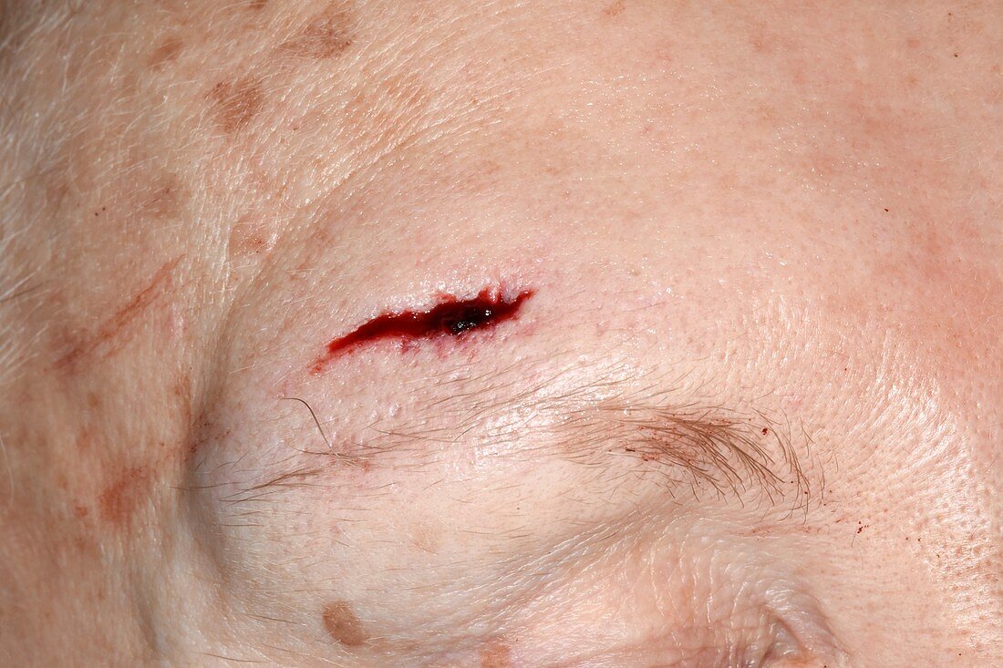 Injured forehead