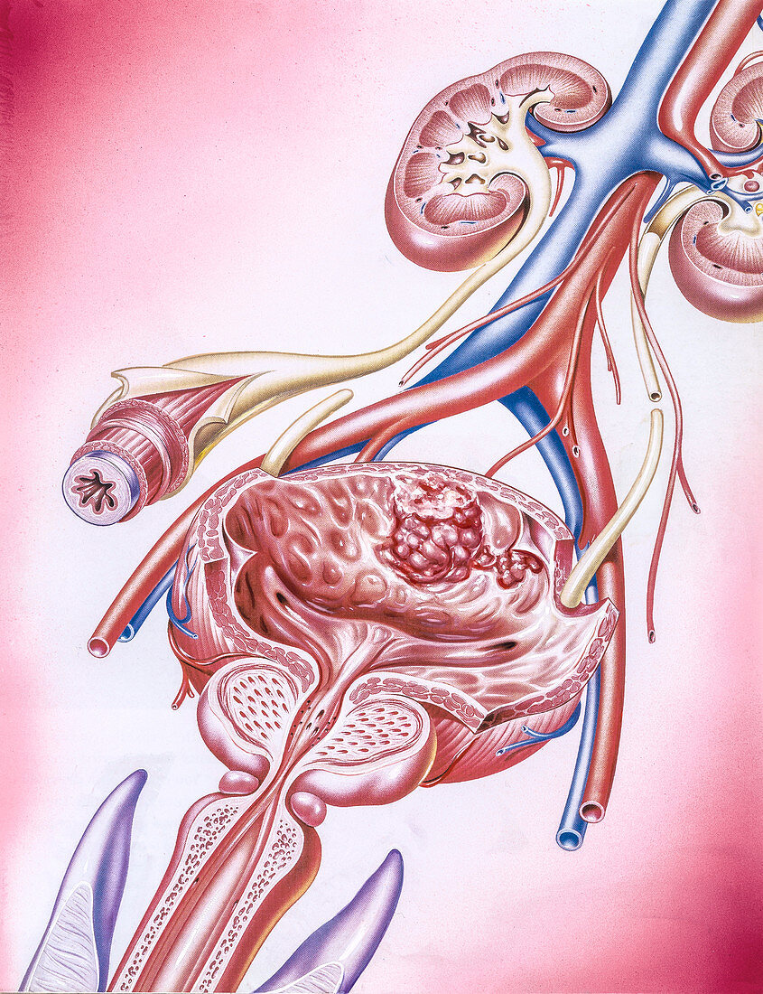 Bladder cancer, illustration