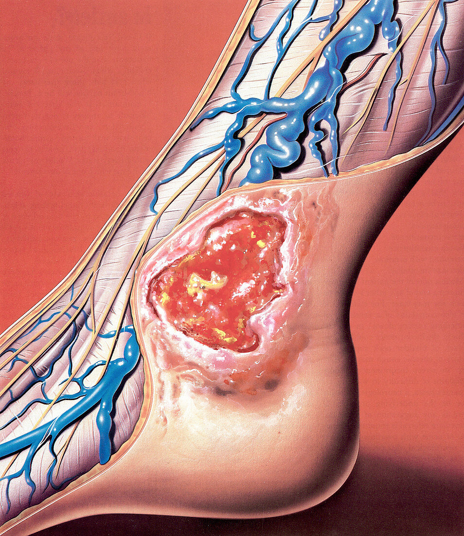 Varicose veins and ulcer, illustration