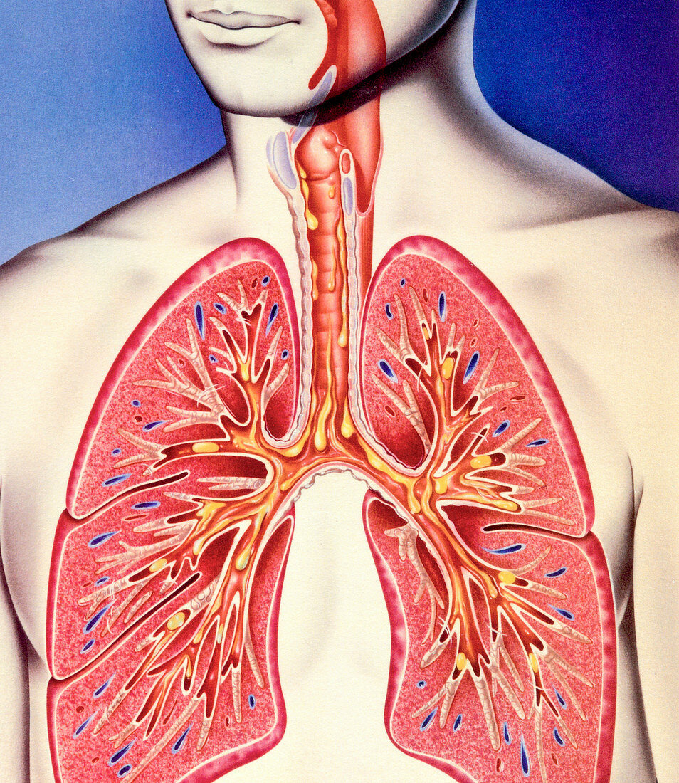 Lower respiratory tract infection, illustration