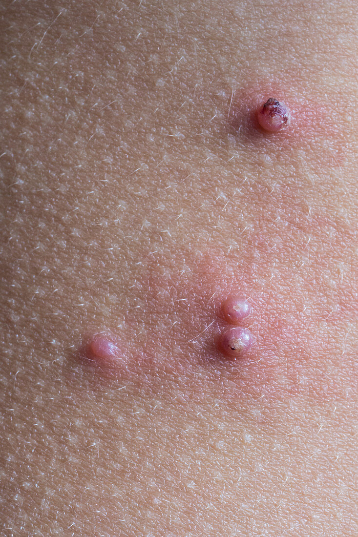 Molluscum contagiosum