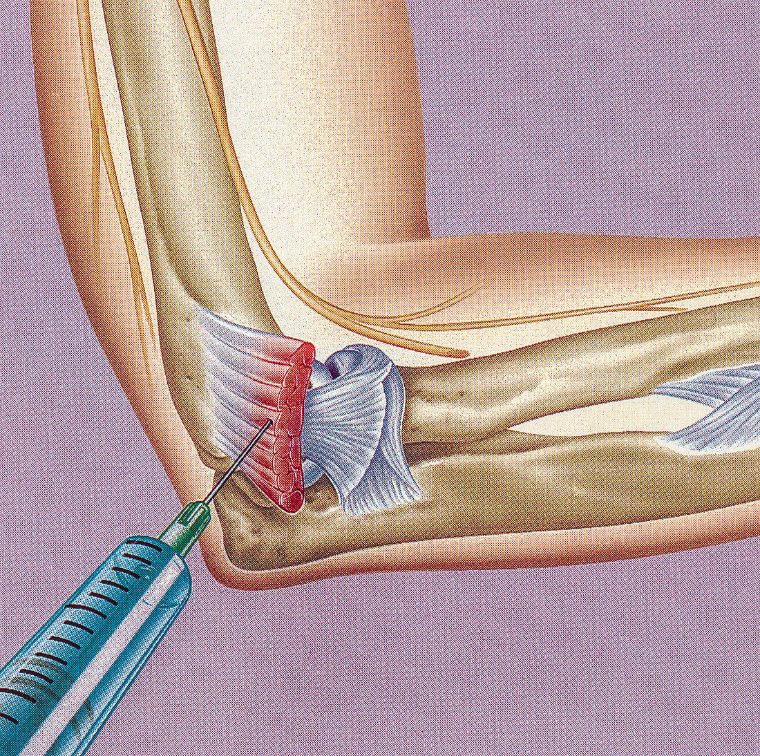 Steroid treatment of teniis elbow, illustration