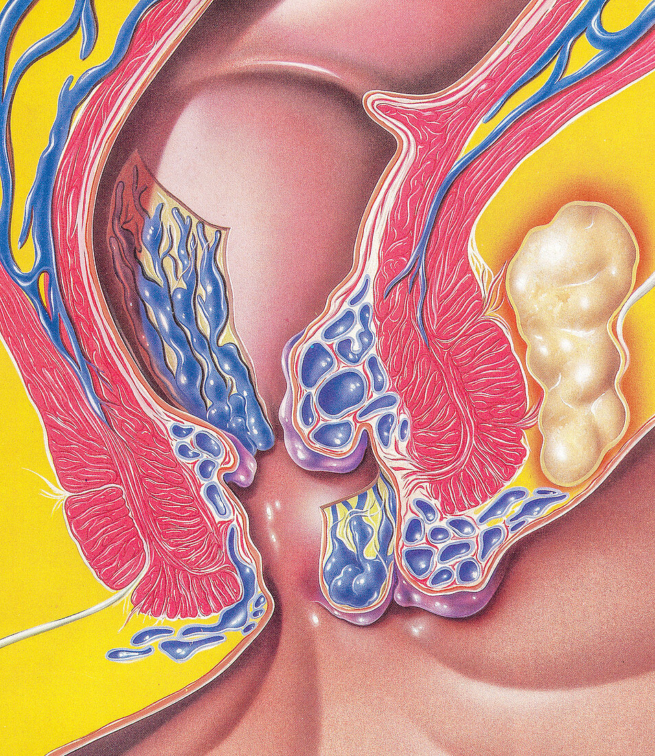 Haemorrhoids and rectal abscess, illustration