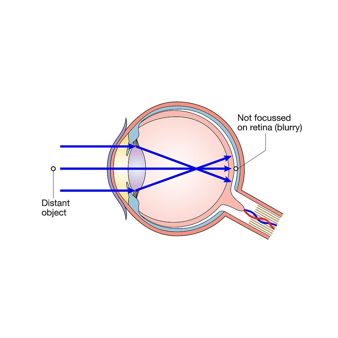 Short-sightedness, illustration