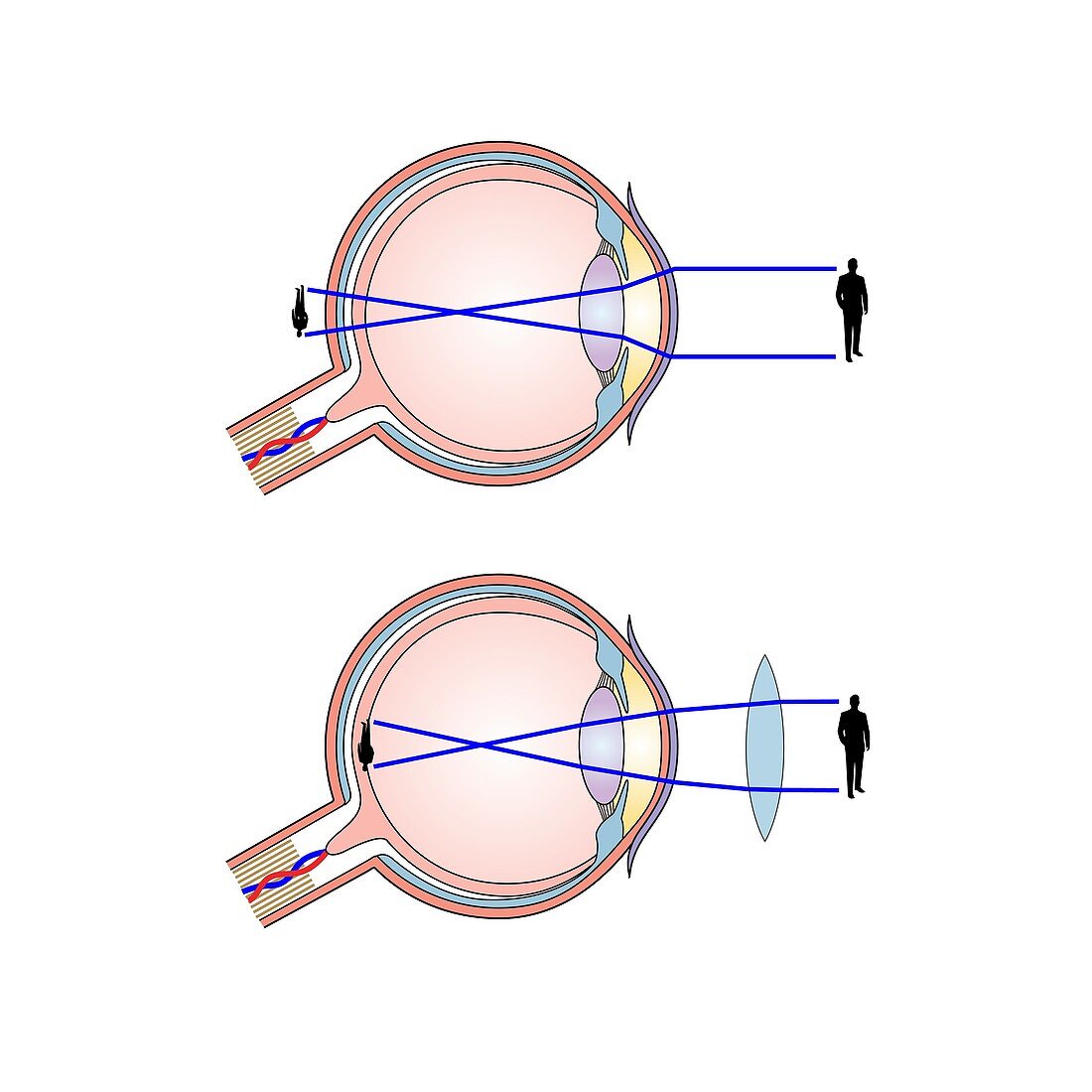 Long-sightedness corrected, illustration