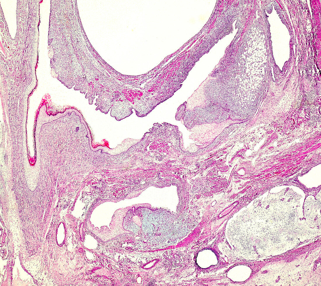 Ovarian mucinous cystadenoma, light micrograph