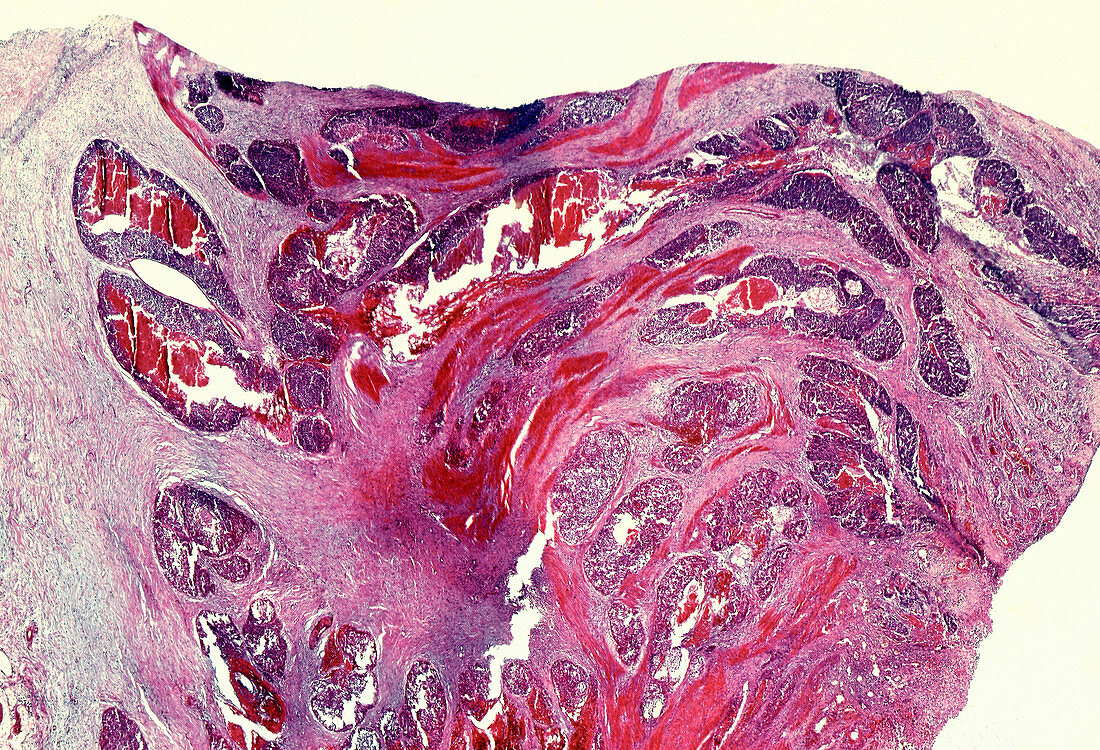 Comedo carcinoma of the breast, light micrograph