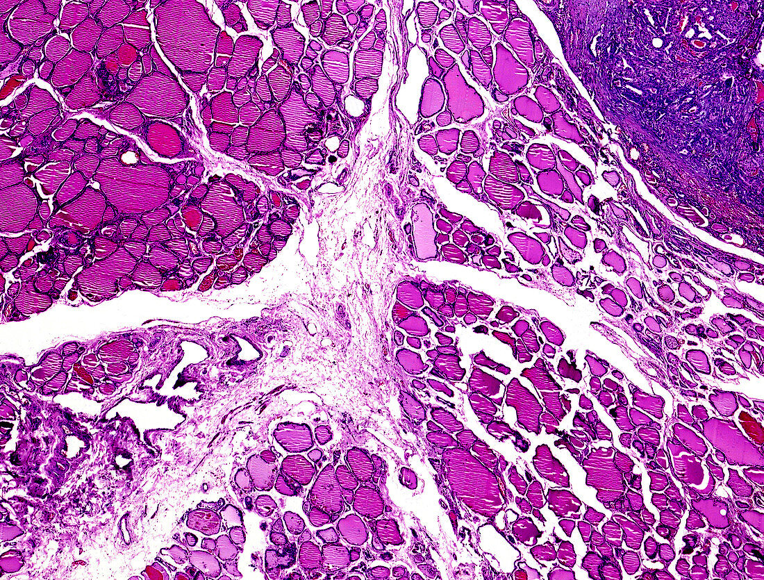 Thyroid cancer, light micrograph