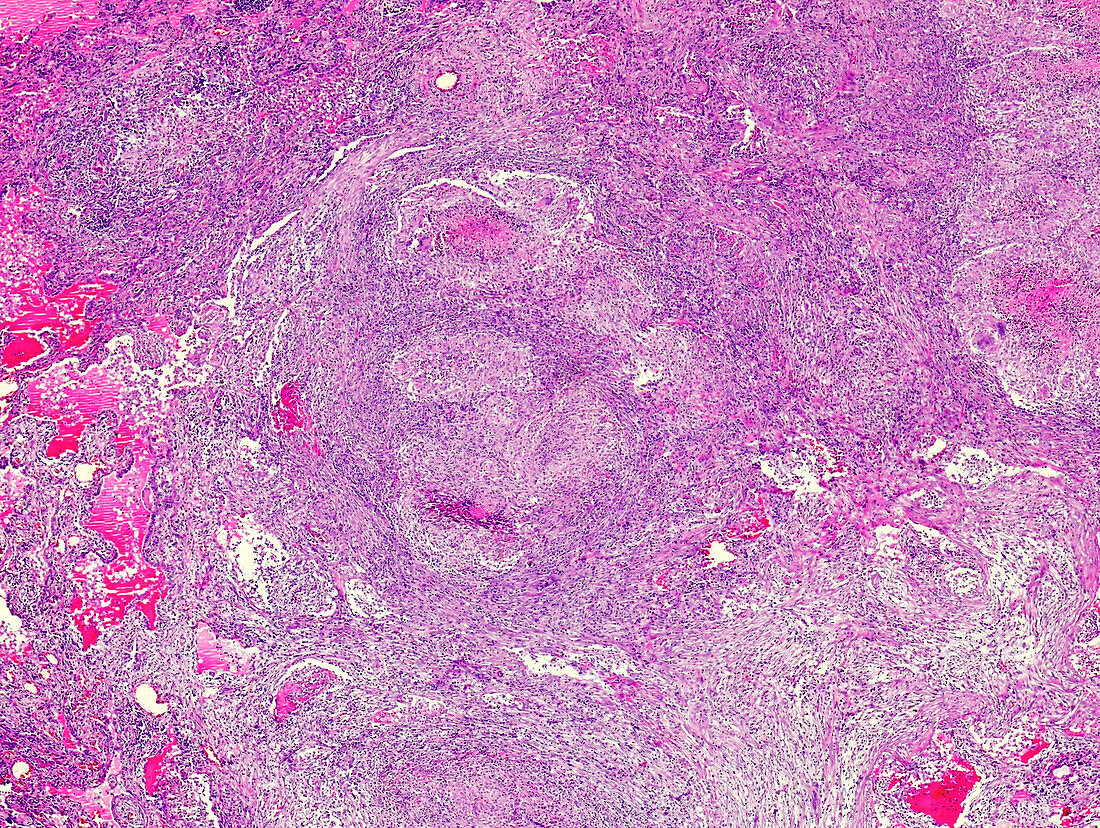 Necrotising lymphadenitis, light micrograph