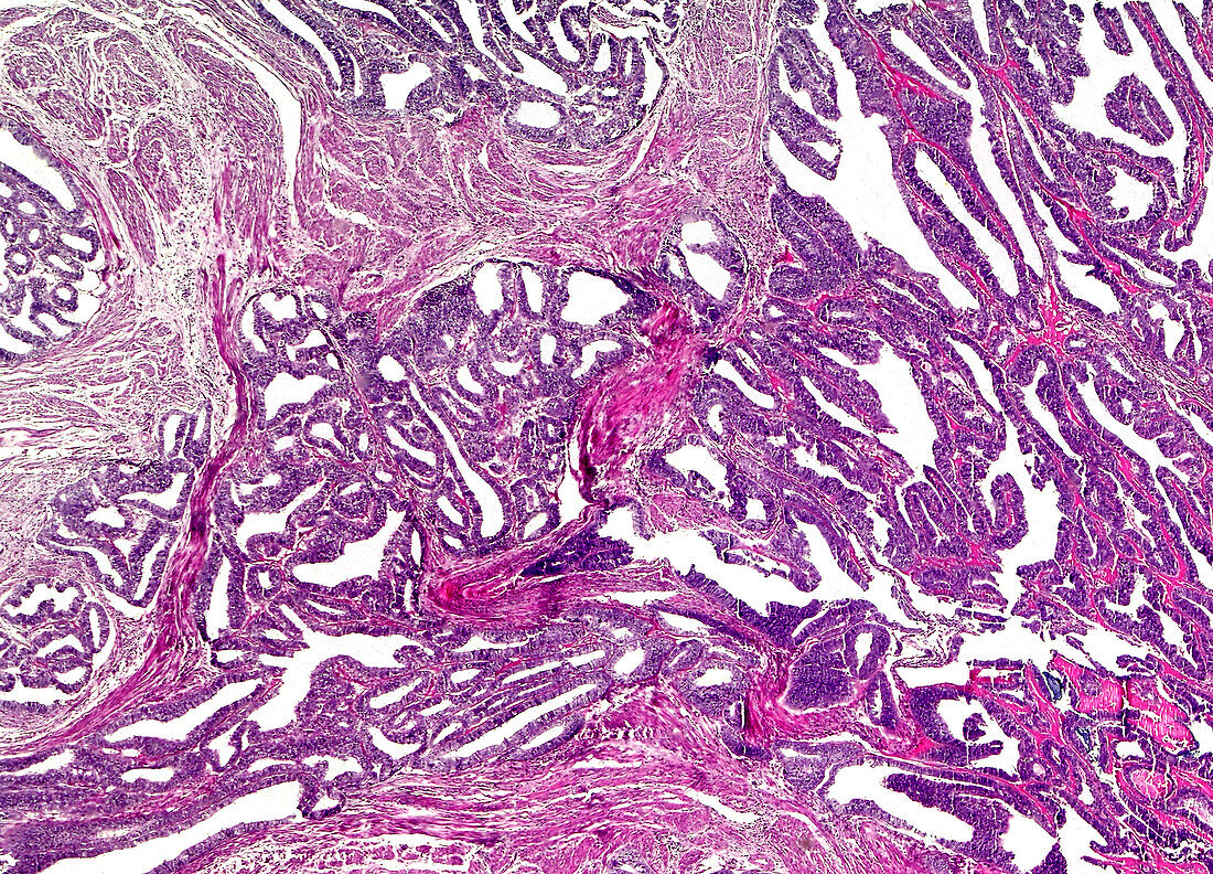 Human glandular cancer, light micrograph