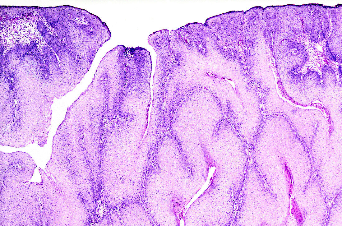 Pointed genital wart, light micrograph