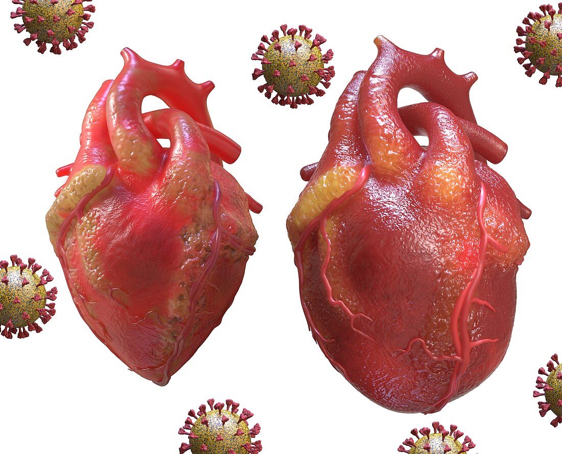 Heart inflammation in Covid-19, conceptual illustration