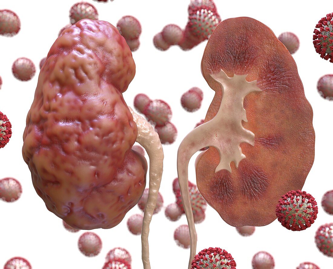Kidney inflammation in Covid-19, conceptual illustration