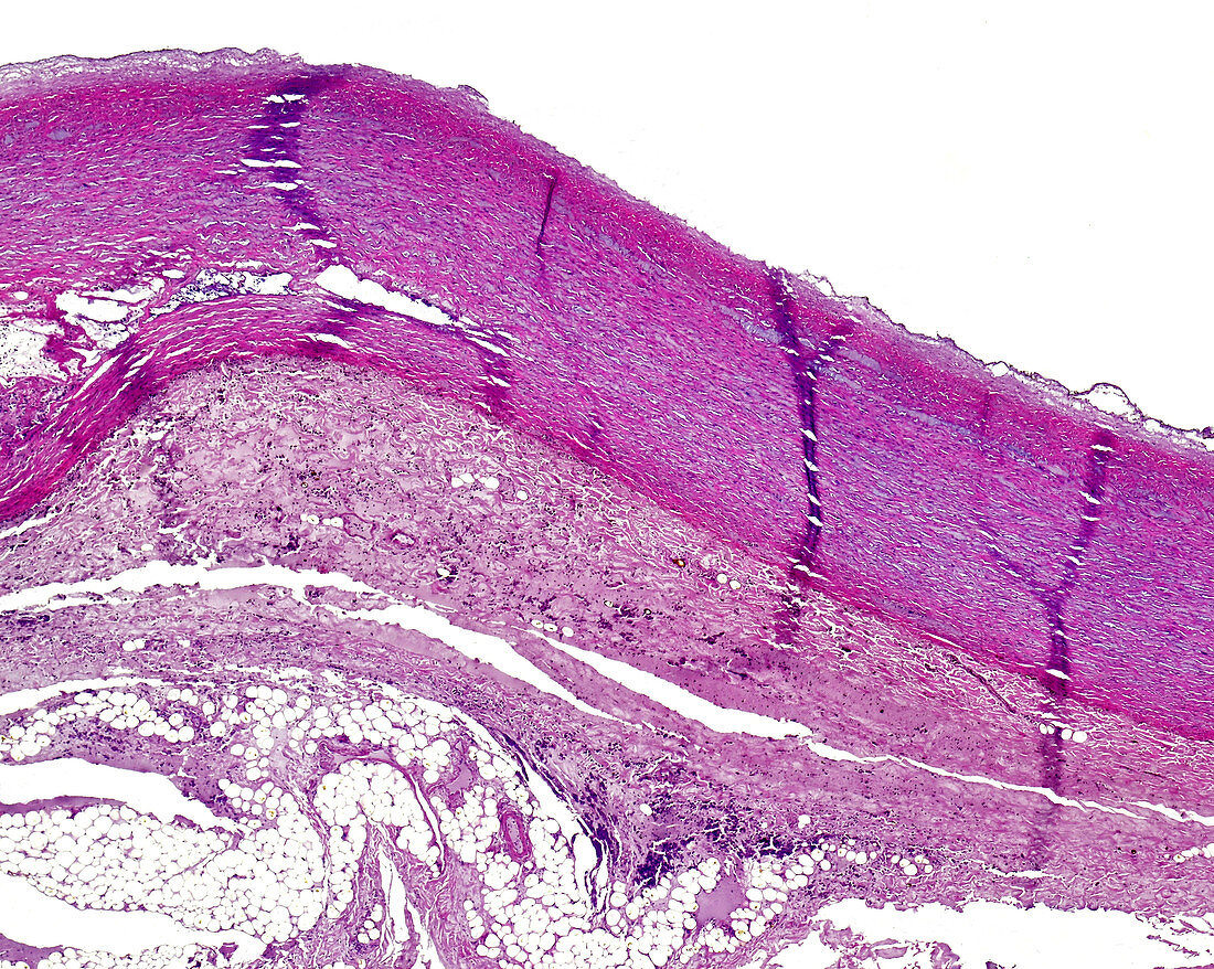 Fibrinoid necrosis of vessel wall, light micrograph